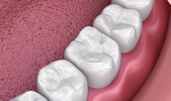 Dental Fillings