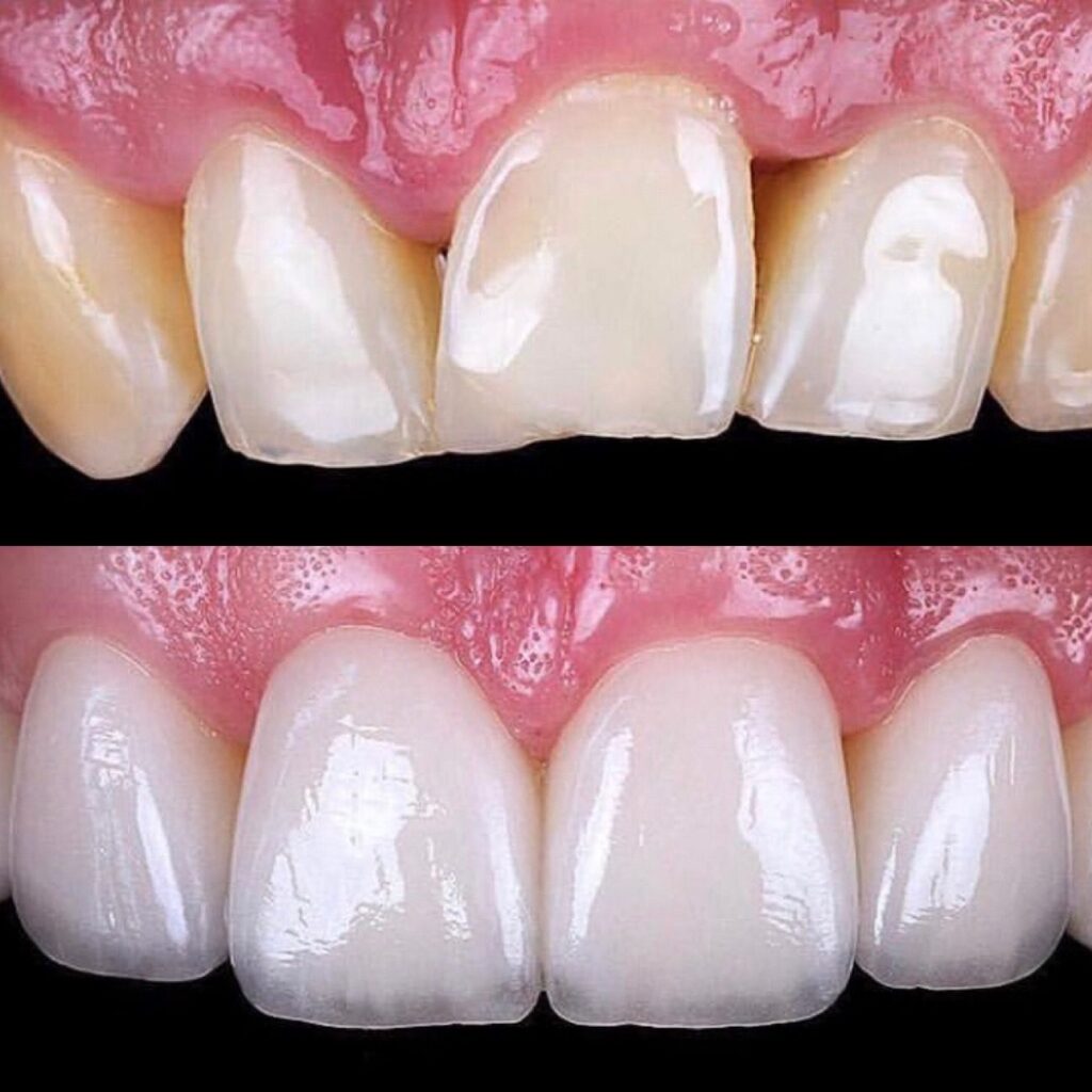 Porcelain Dental Veneers 7 Dental Veneers Patient