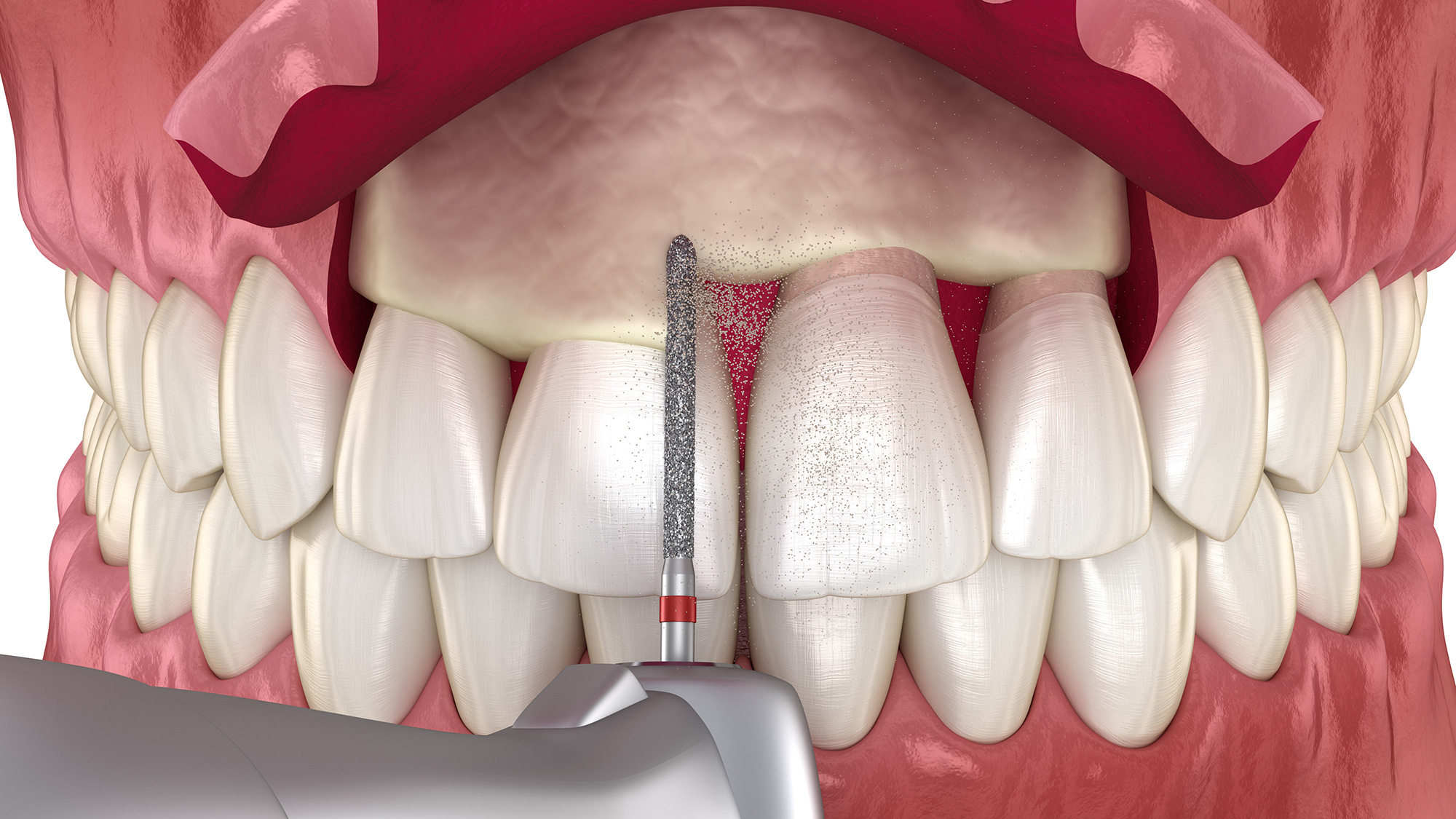 Dental Crowns 14 Crown Lengthening