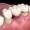 Cosmetic Dentistry vs Restorative Dentistry: Dental Bridges