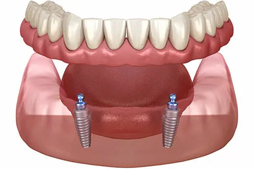 Graphic rendering of dental implants to illustrate what is restorative dentistry.