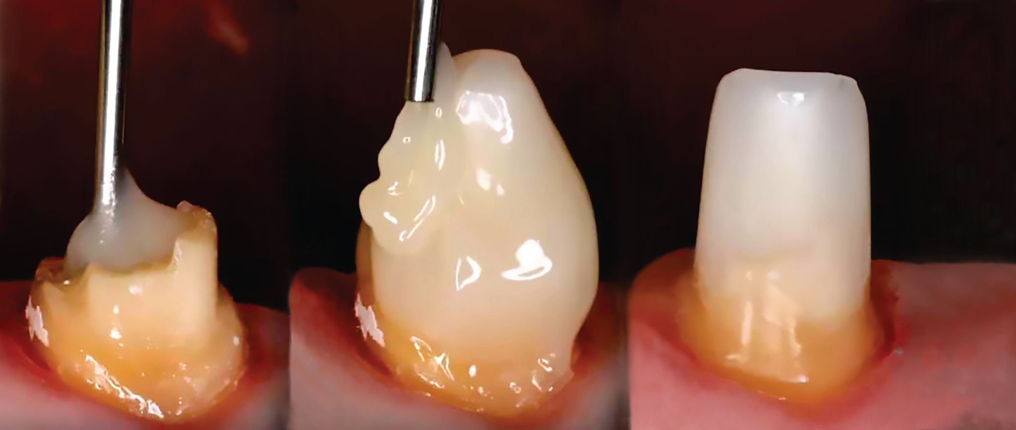 Dental Crowns 12 Post Core buildup2