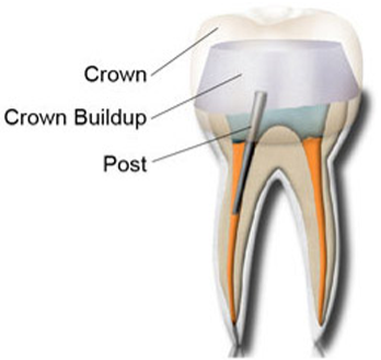Dental Crowns 11 Post core buildup
