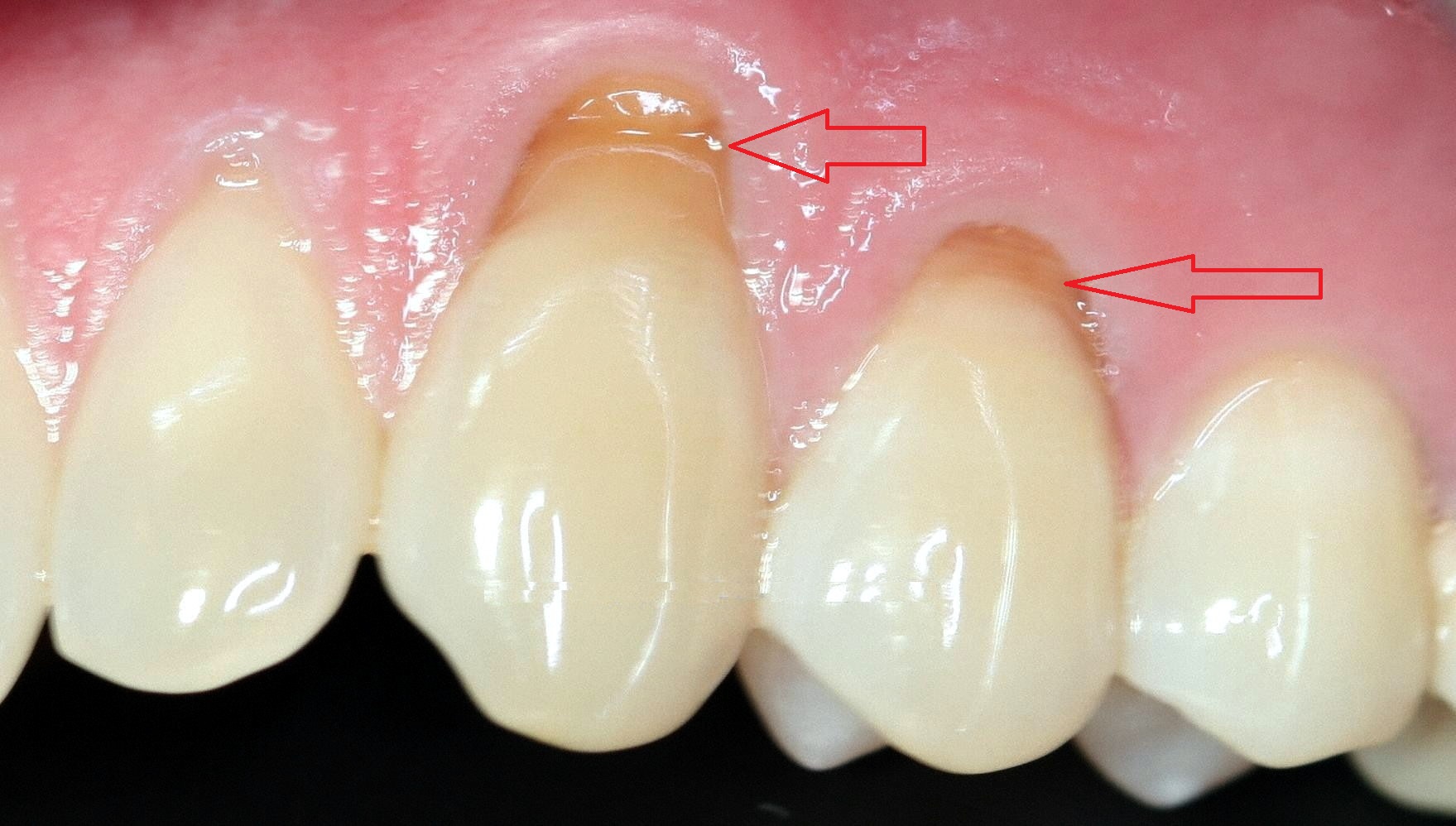 Night Guard 4 dental abfraction