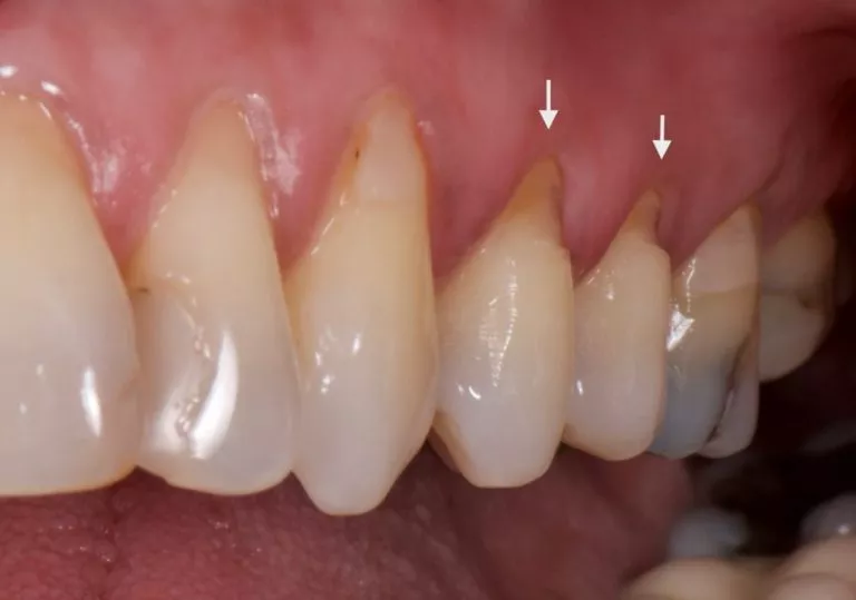 Night Guard 5 dental abfraction2
