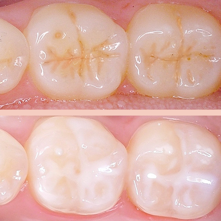 Dental Sealants 4 dental sealants for kids