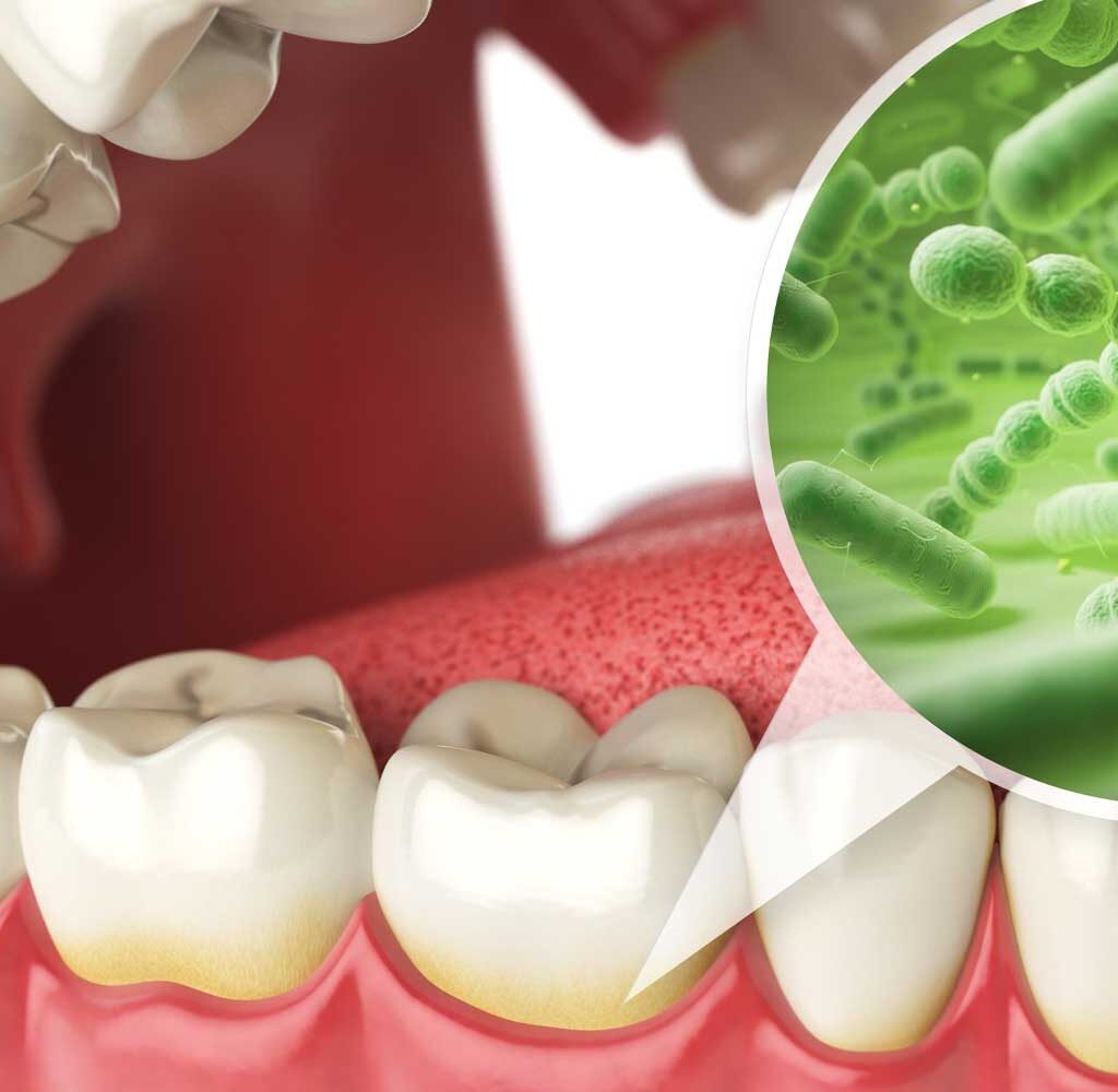Deep Teeth Cleaning 4 Deep Teeth Cleaning