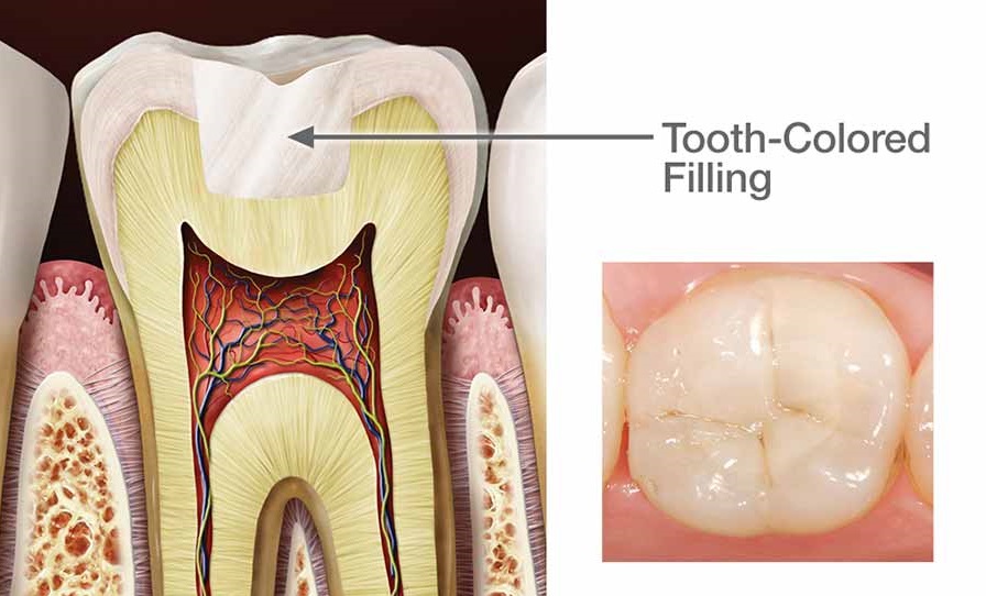 Dental Fillings 3 tooth colored dental filling