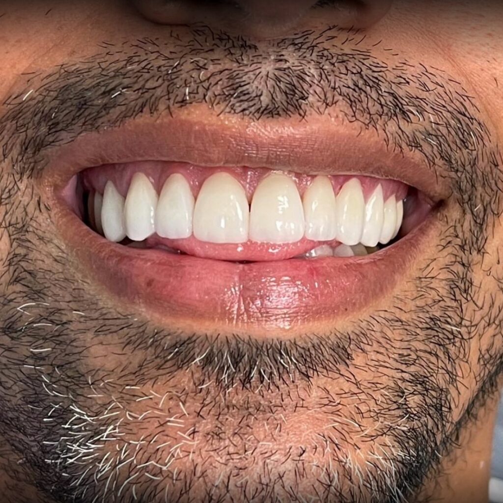 Close-up of a mouth of a smiling man to show his Crowns to help illustrate what is restorative dentistry