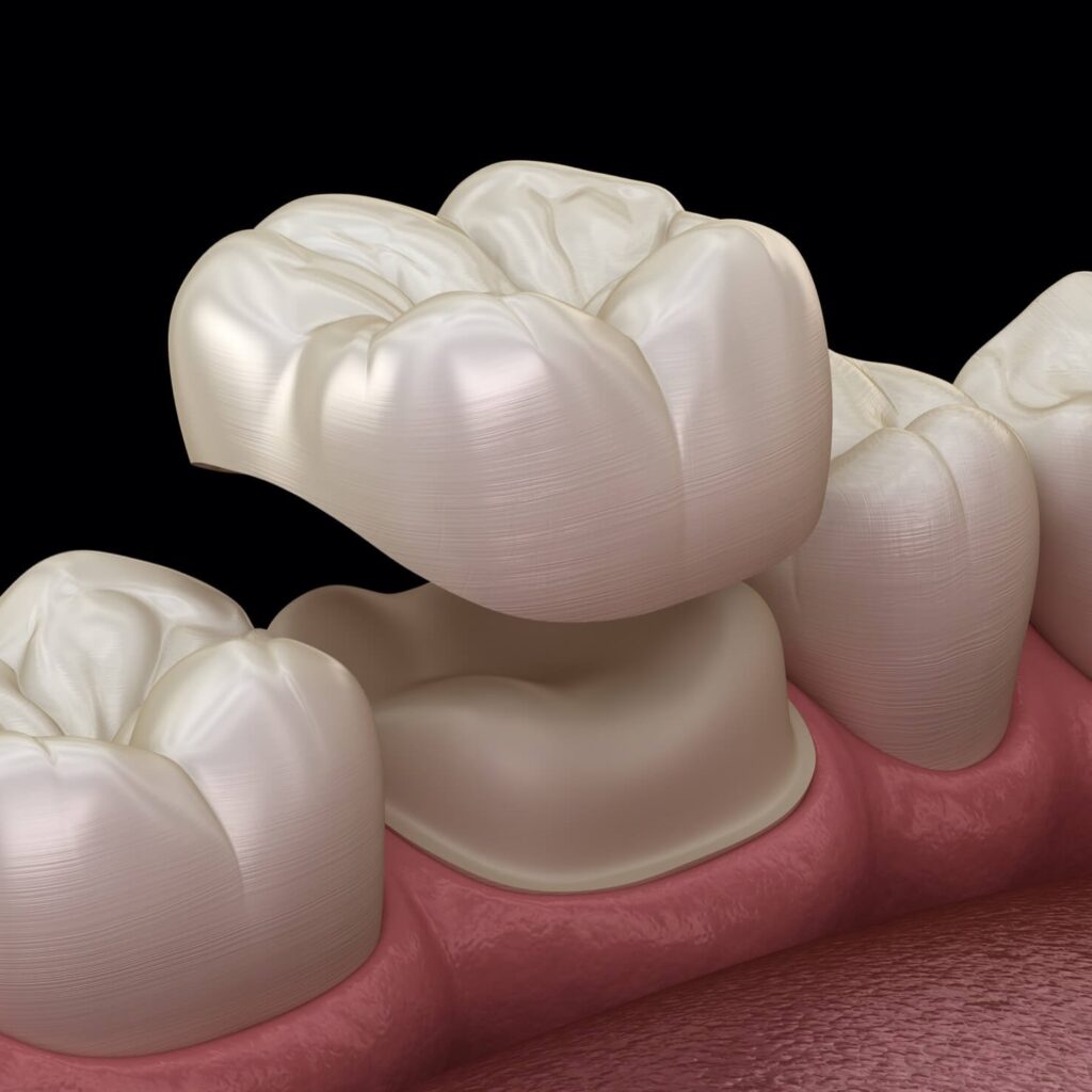 dental crowns