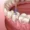 root canal procedure