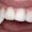 dental sealants applied to teeth