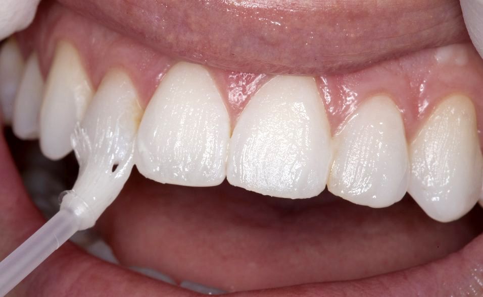 dental sealants applied to teeth