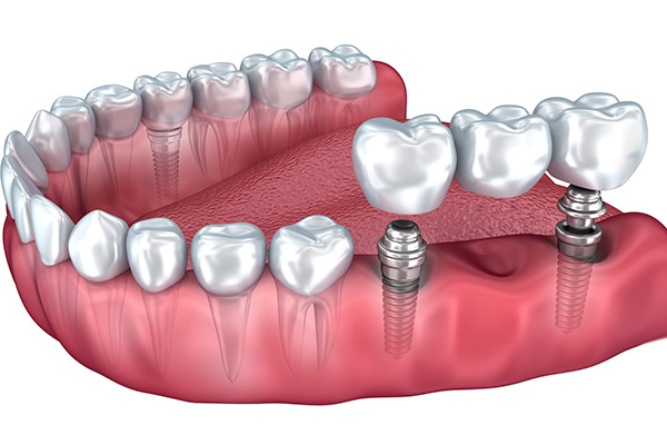 A 3D illustration of dental implant bridges