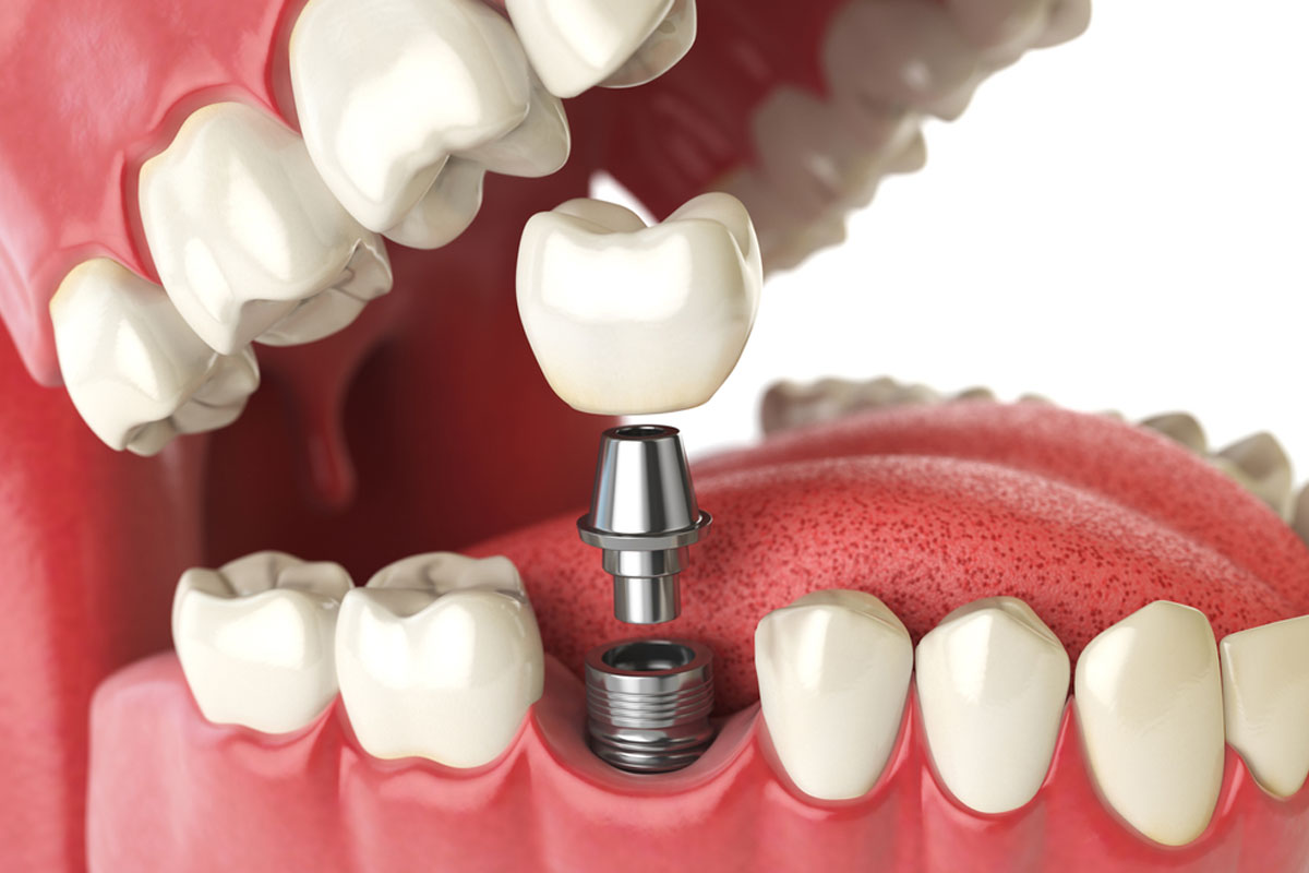 A 3D illustration that shows the components of a dental implant