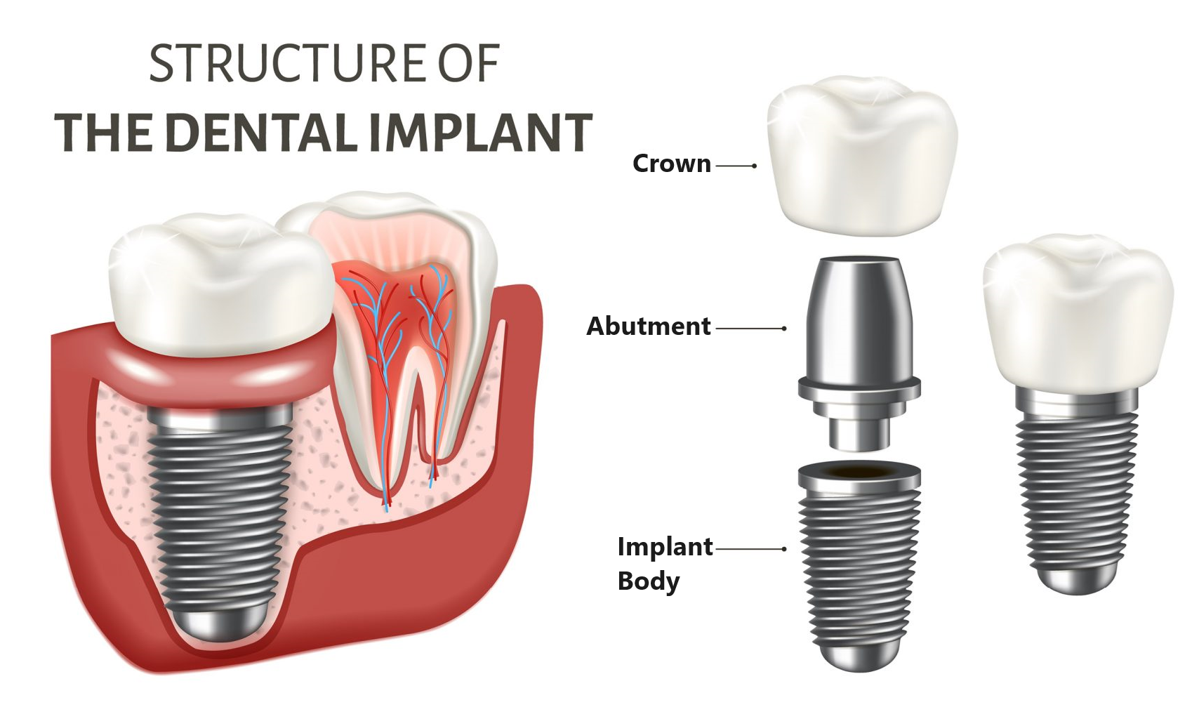 An image detailing the structure of a dental implant
