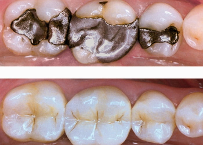 before after dental crowns