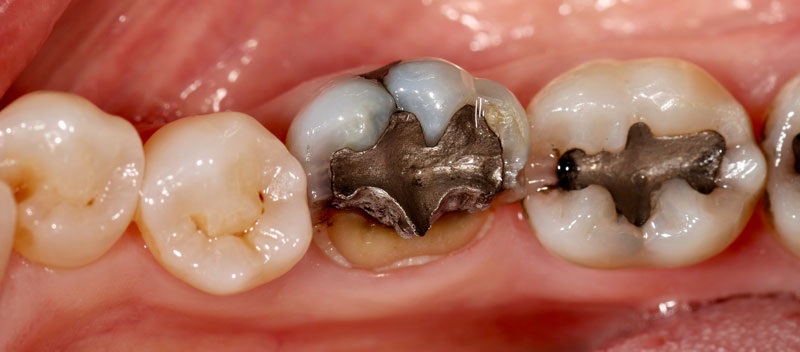 before and after dental crown restorations