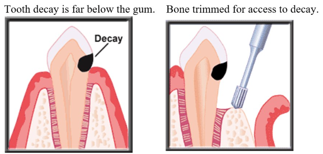 Crown lengthening for dental crowns