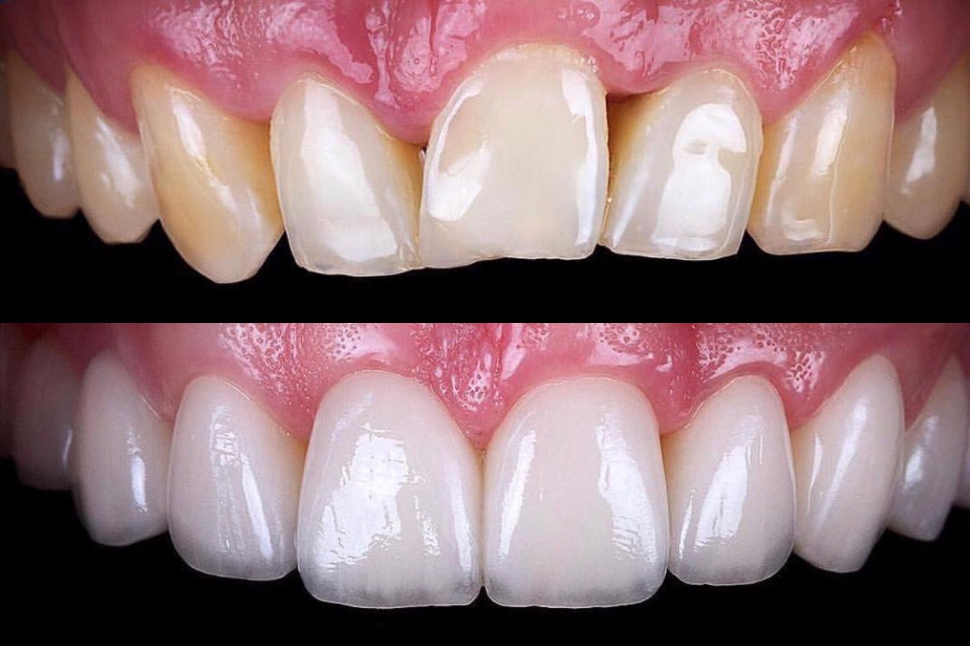 before and after dental veneers