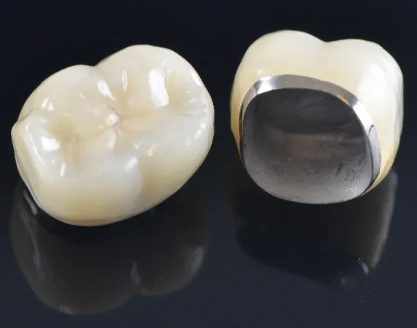 Porcelain-fused-to-metal crowns