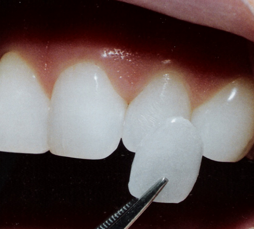 holding a porcelain veneer near a natural tooth