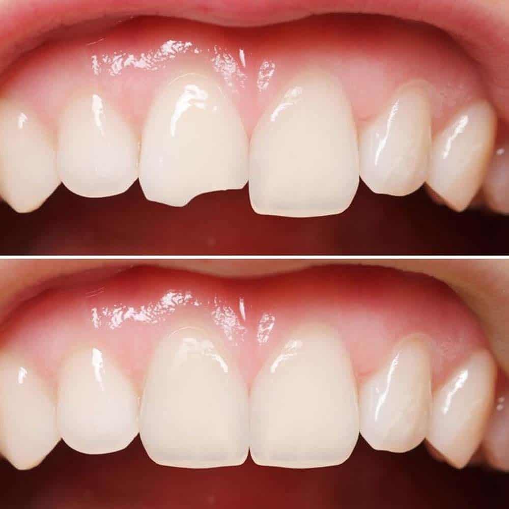 Before and after porcelain veneers
