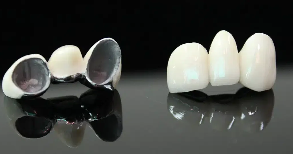 PFM dental bridges