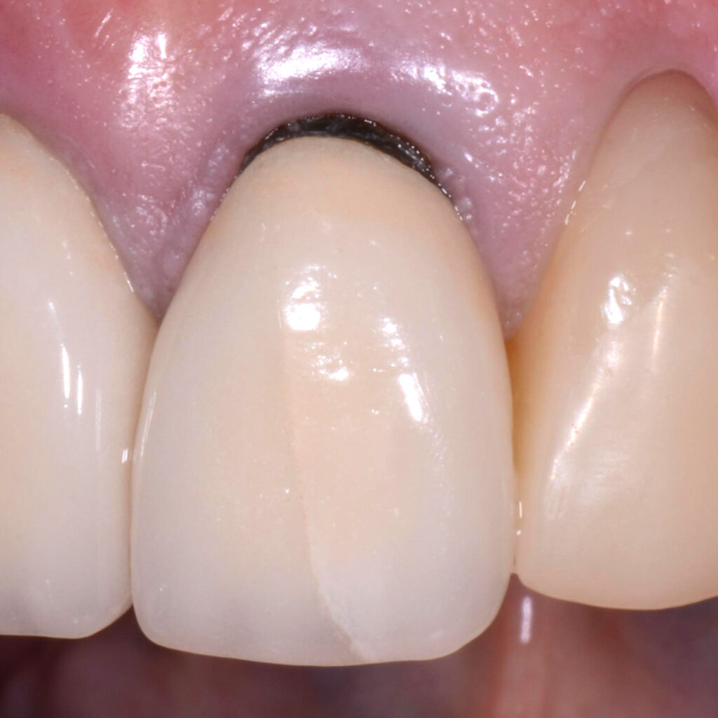 black line at the gum line