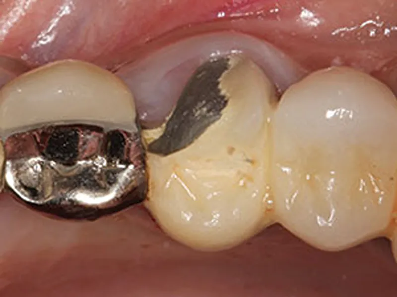 broken porcelain layer of a dental bridge