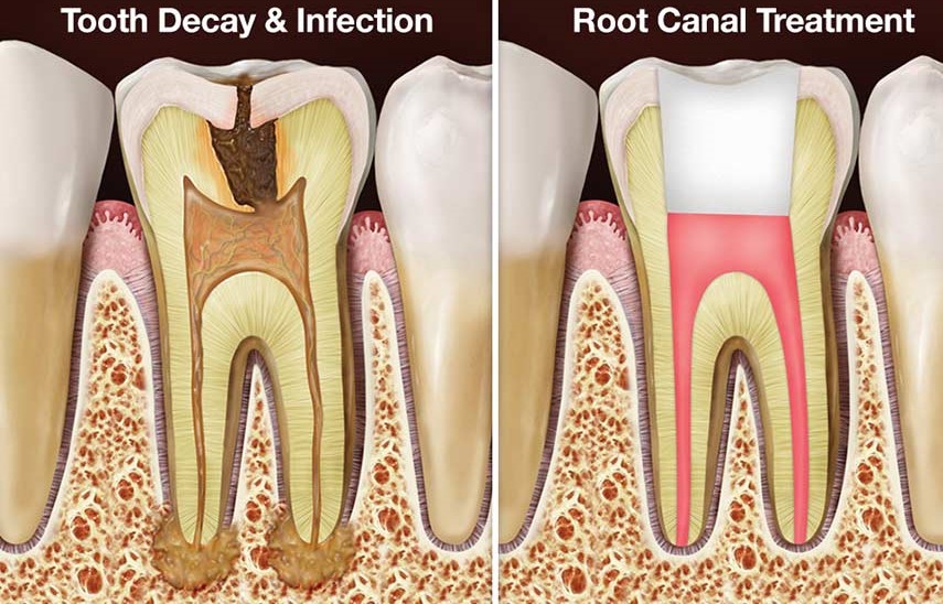 before and after root canal treatment