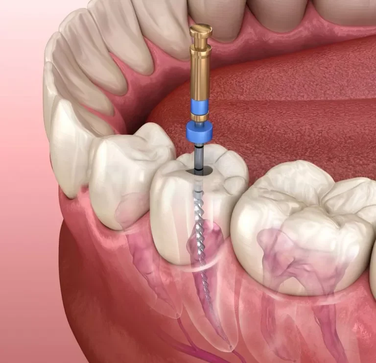 an infected tooth being drilled