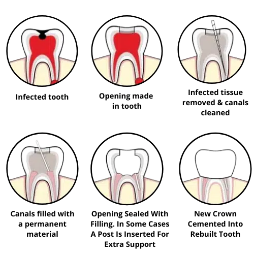 step-by-step endo root canal treatment procedure