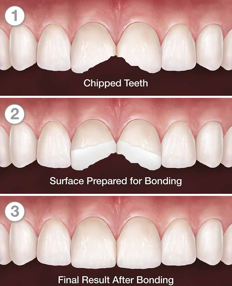 step-by-step process of dental filling placement