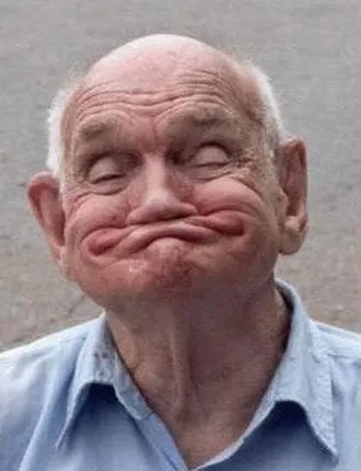 an older man with missing teeth and no dentures