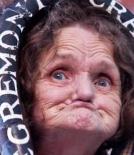 an older woman with missing teeth and no dentures